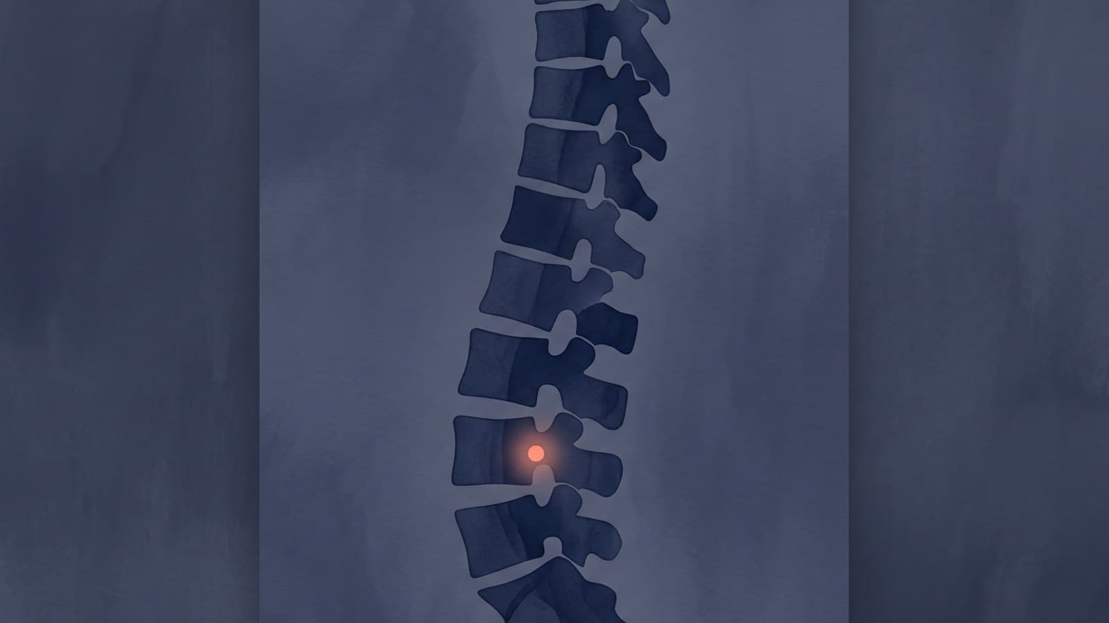 Minimally Invasive Spine Surgery